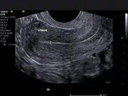 ultrasound of a uterus