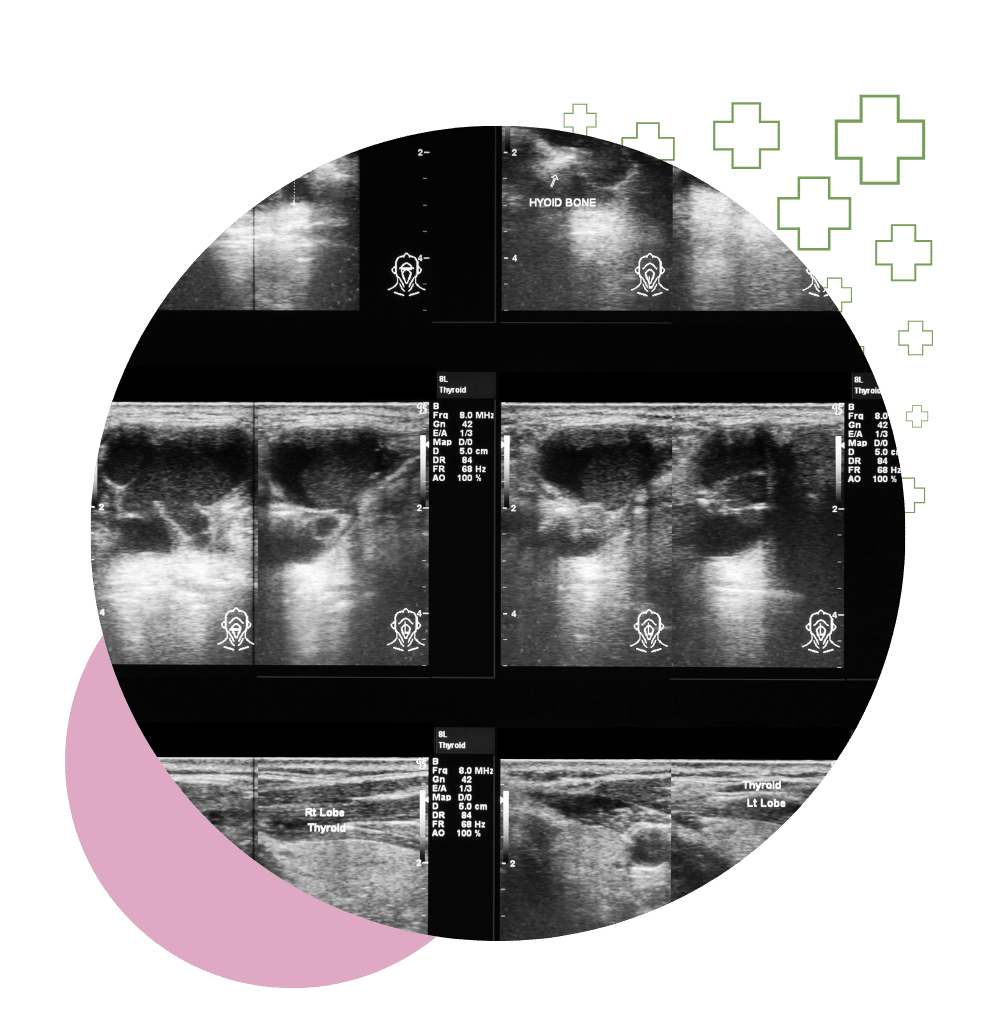 Black and white diagnostic ultrasound images of the thyroid gland showing labeled sections and lobe analysis.