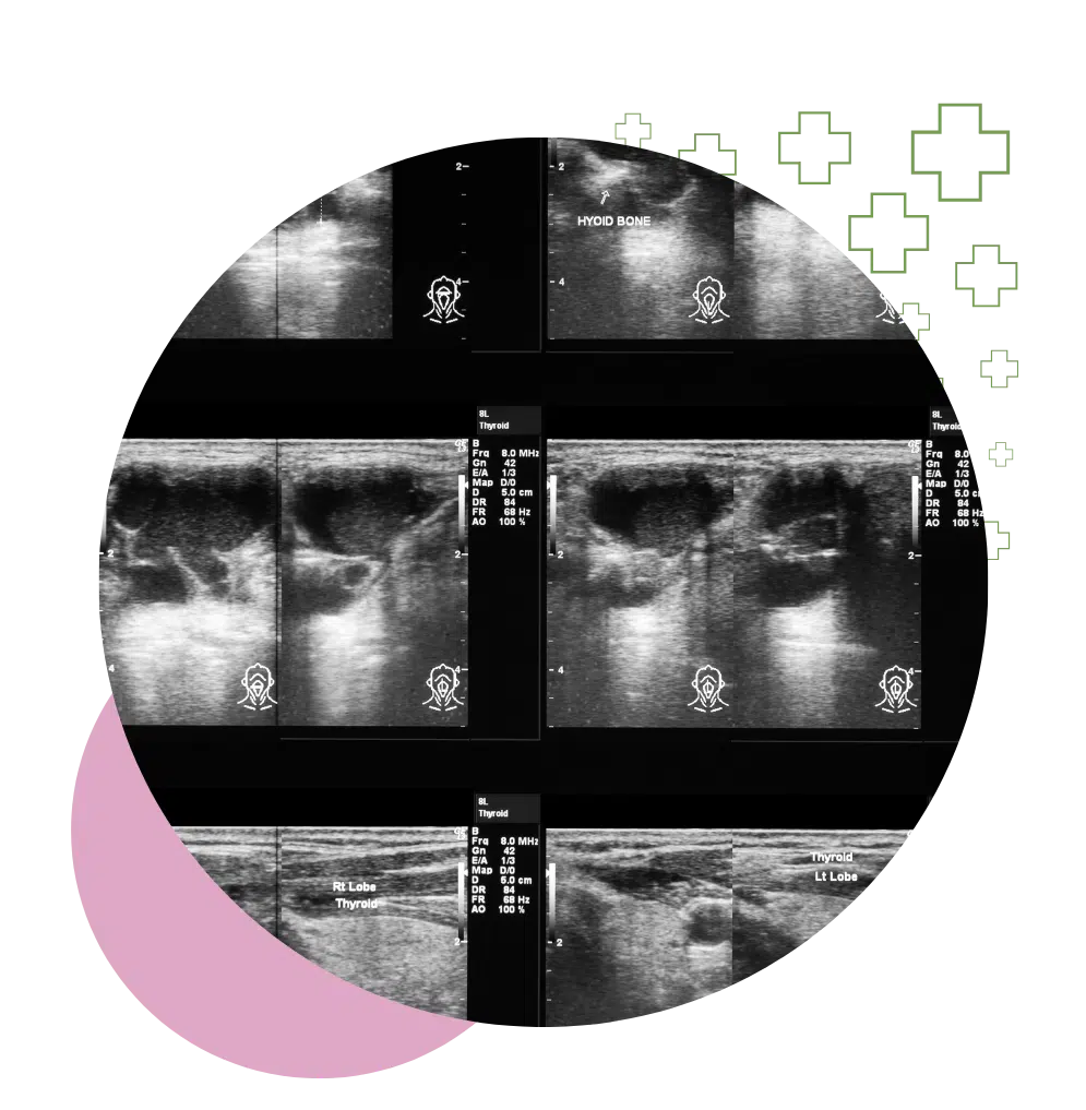 Black and white diagnostic ultrasound images of the thyroid gland showing labeled sections and lobe analysis.